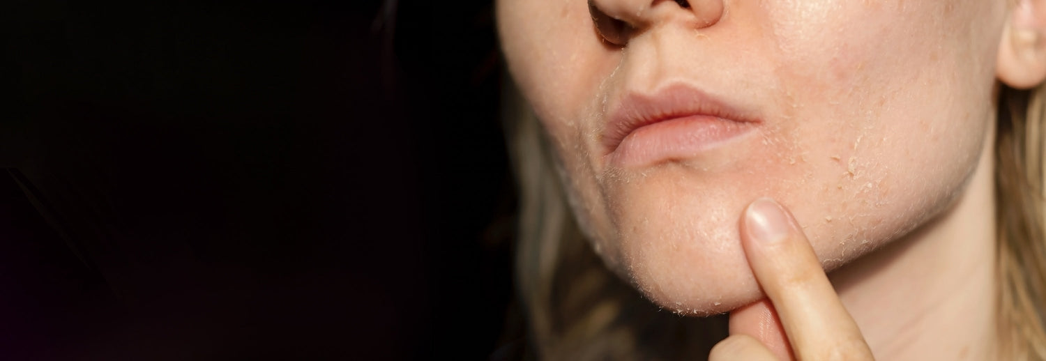 A woman with dry skin showing clear signs of facial skin irritation and flaking