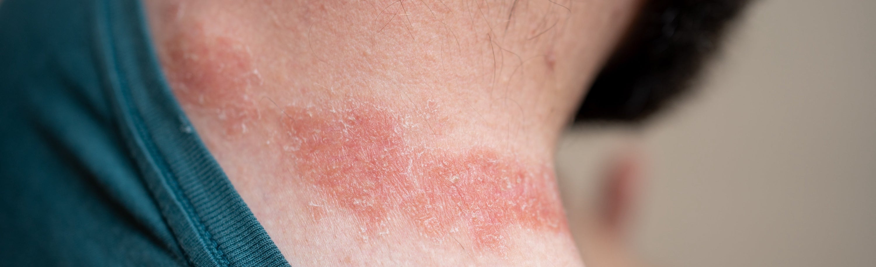 The image is a close-up shot focusing on the side of a person’s neck and upper shoulder, revealing a significant skin irritation.
